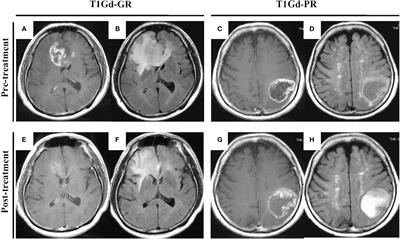 Impact of Neoadjuvant Bevacizumab on Neuroradiographic Response and Histological Findings Related to Tumor Stemness and the Hypoxic Tumor Microenvironment in Glioblastoma: Paired Comparison Between Newly Diagnosed and Recurrent Glioblastomas